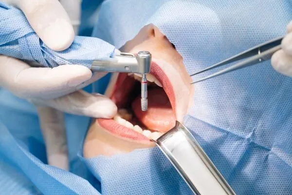 dich-vu-trong-rang-implant-hai-phong