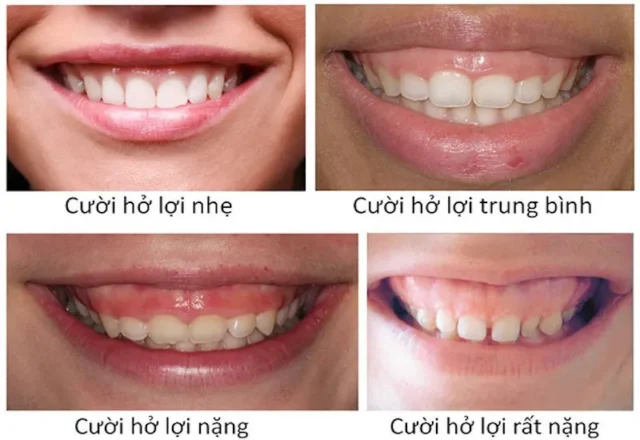 dieu-tri-ho-loi-hai-phong-1