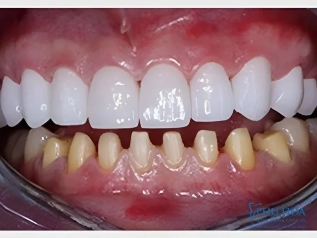 bọc răng sứ có phải mài răng không