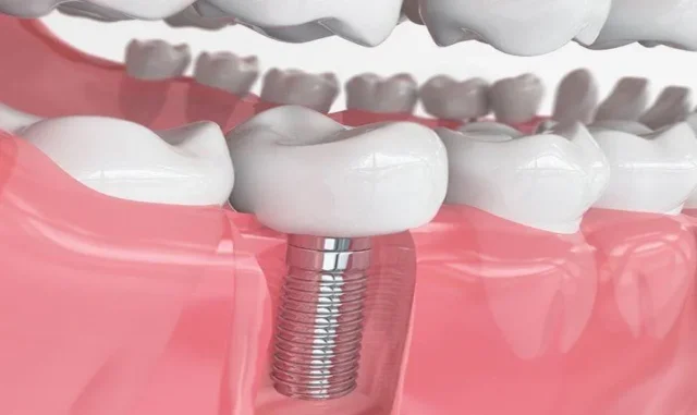 Trồng Implant Răng Số 7