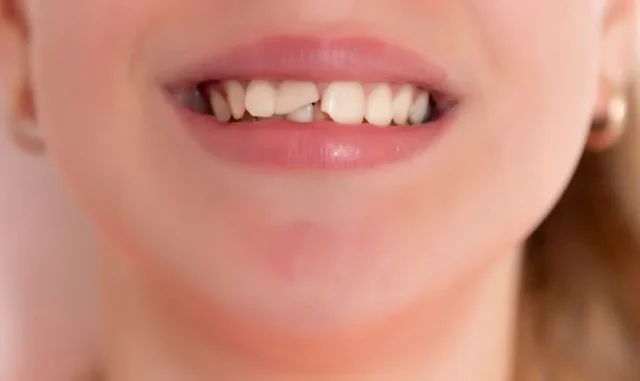 Giải Pháp Khi Bạn Bị Mẻ Răng