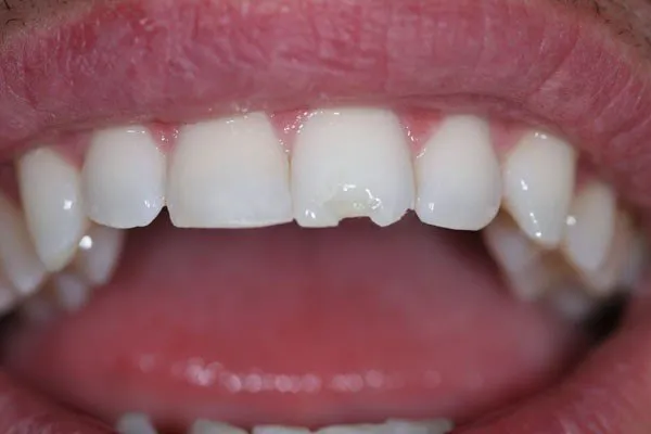 Nhận Biết Mức Độ Mẻ Răng