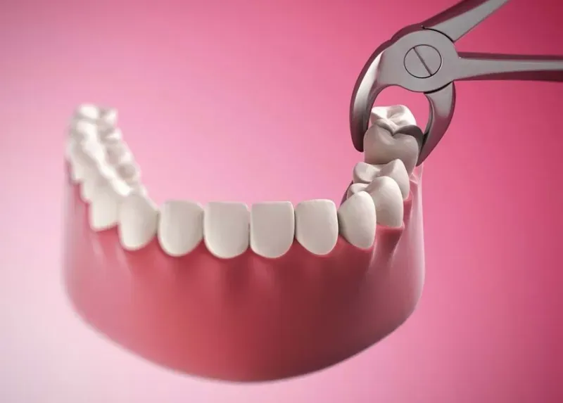 Cách điều trị răng sâu nặng hiệu quả