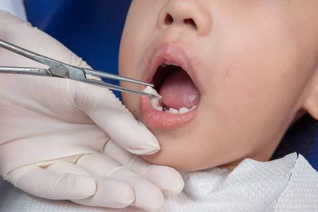 Những Lưu Ý Quan Trọng Trong Quá Trình Thay Răng