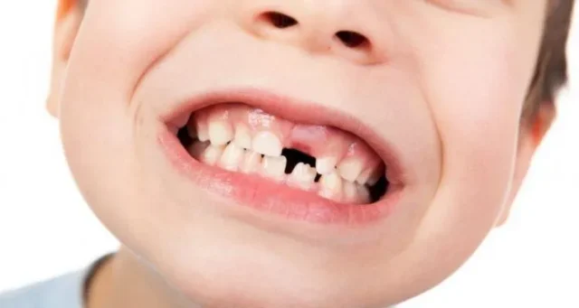 Nguyên nhân khiến răng sữa không thay