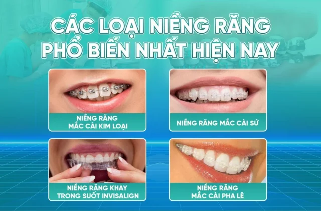 niềng răng bao lâu thì đều