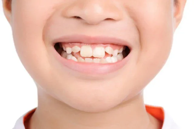Nguyên Nhân Hình Thành Răng Cánh Bướm