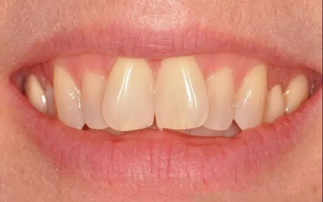 Răng cánh bướ là một khuyết điểm về hình dáng răng