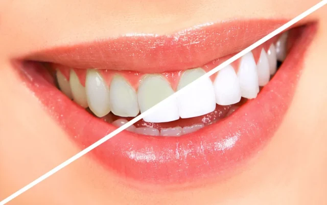 tẩy trắng răng có hại men răng không