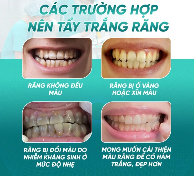 tẩy trắng răng có hại men răng không