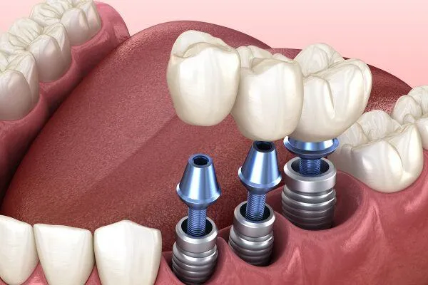 Trồng răng implant có đau không
