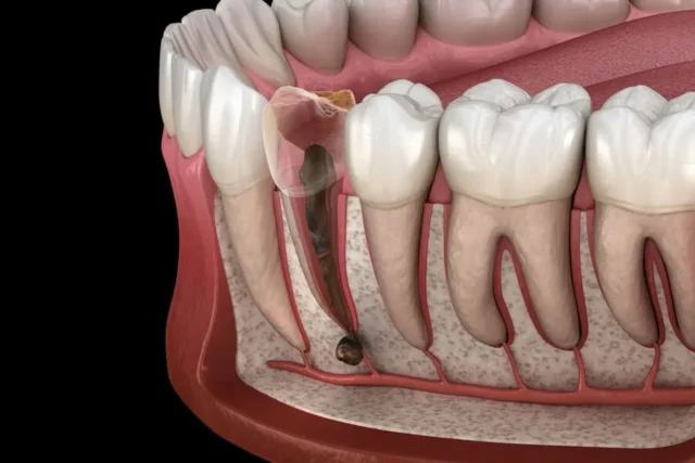 bị sưng lợi chân răng