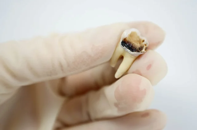 Nguyên Nhân Gây Tủy Răng Chết