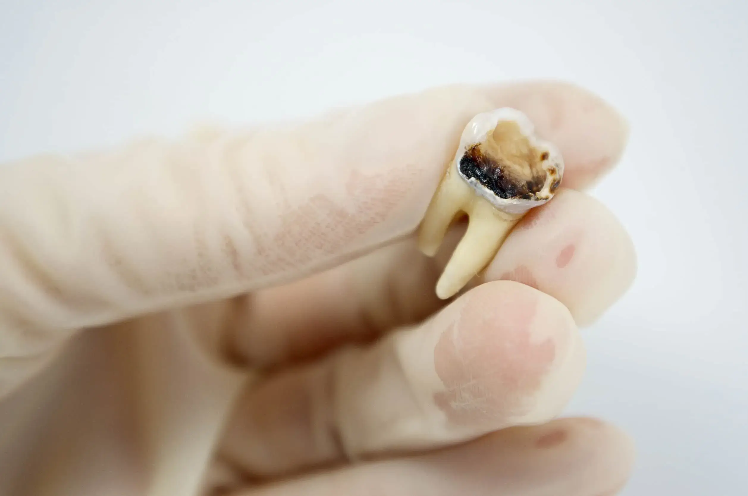 Nguyên Nhân Gây Tủy Răng Chết