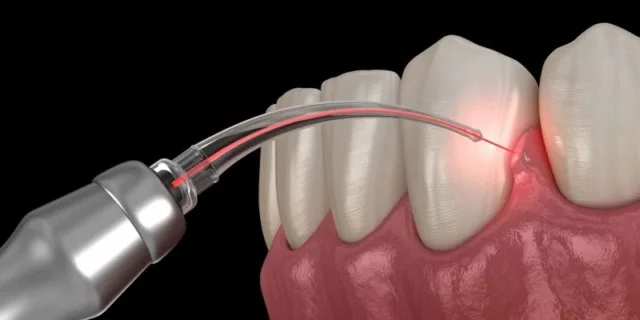 Các Yếu Tố Ảnh Hưởng Đến Cảm Giác Đau Sau Cắt Lợi Laser