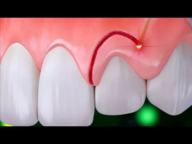 Cắt lợi bằng laser đang ngày càng phổ biến