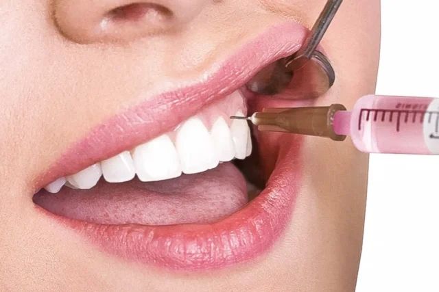 trồng răng số 7