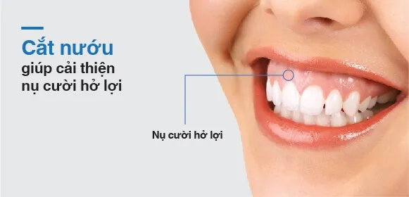 Cắt lợi giúp nụ cười tự tin