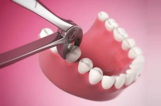 Đối tượng cần làm cầu răng số 6