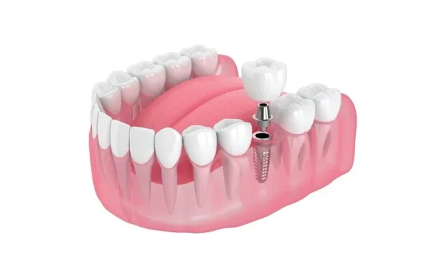 Ưu điểm của cầu răng số 6