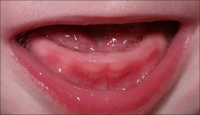 trẻ sốt mọc răng