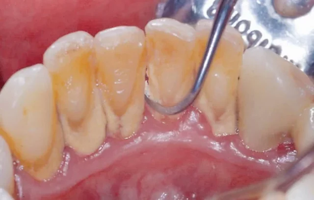 lấy cao răng có hại gì không