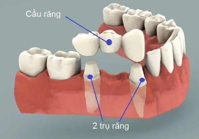 mầm răng vĩnh viễn