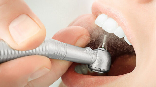 lấy cao răng có hại gì không