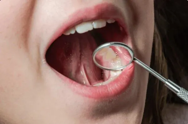 răng mọc ngầm có cần nhổ không