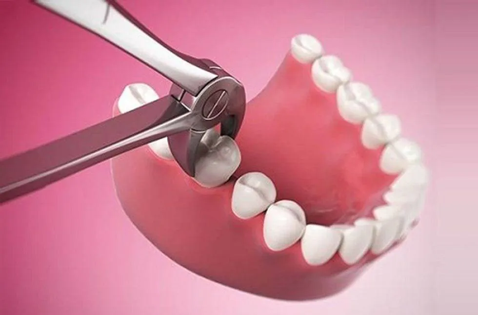 Răng số 6 hàm dưới có thay không
