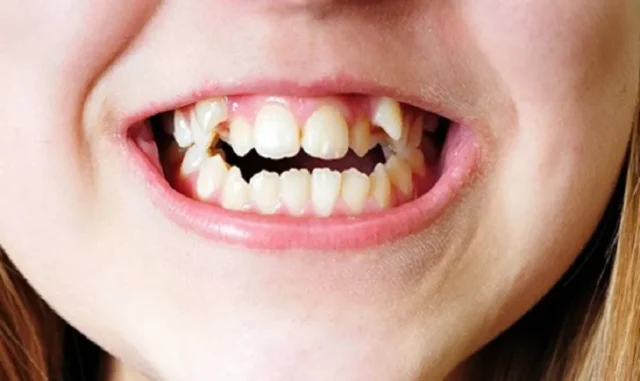 răng có dài ra không