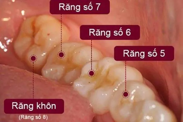 Răng hàm số 5 có thay không