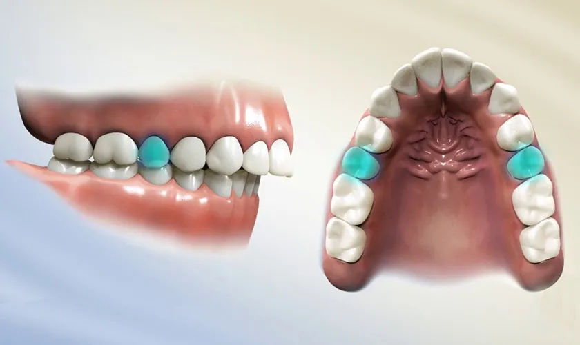 Răng hàm số 5 có thay không
