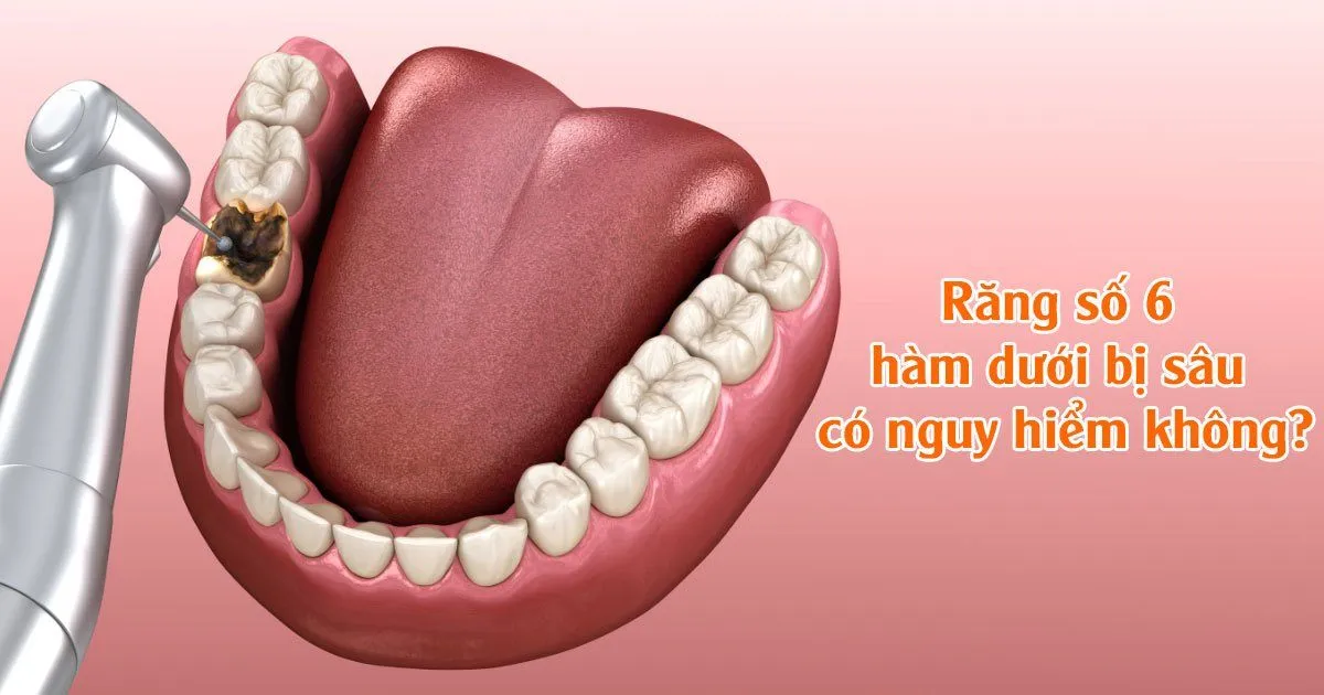 Răng số 6 hàm dưới có thay không