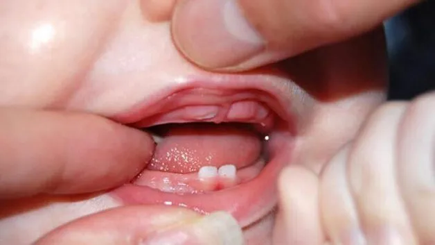 trẻ sốt mọc răng