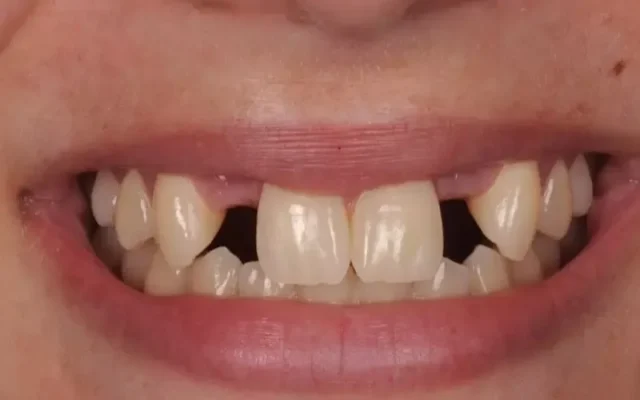 trẻ không có mầm răng