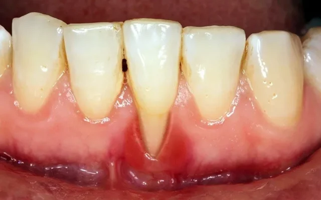 răng có dài ra không