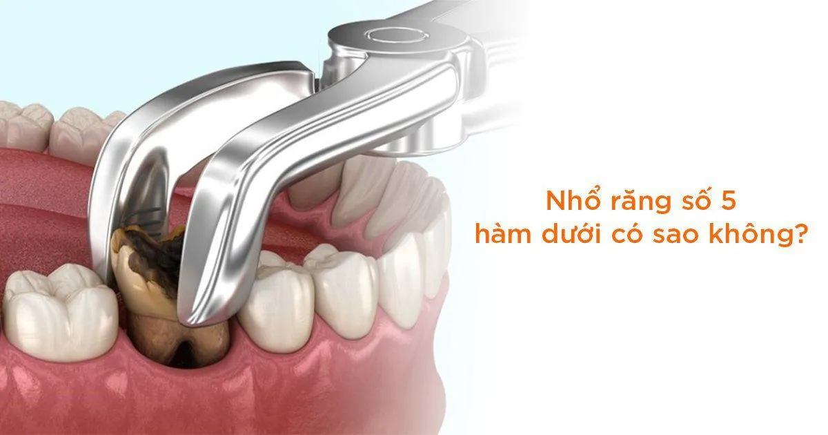 thay răng số 5 hàm dưới