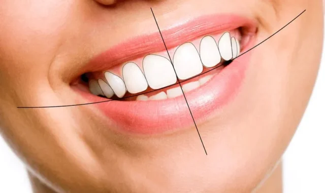 niềng răng 10 triệu