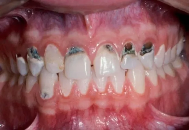 các mảng bám đen trên răng