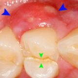 hình ảnh viêm nướu răng ở trẻ