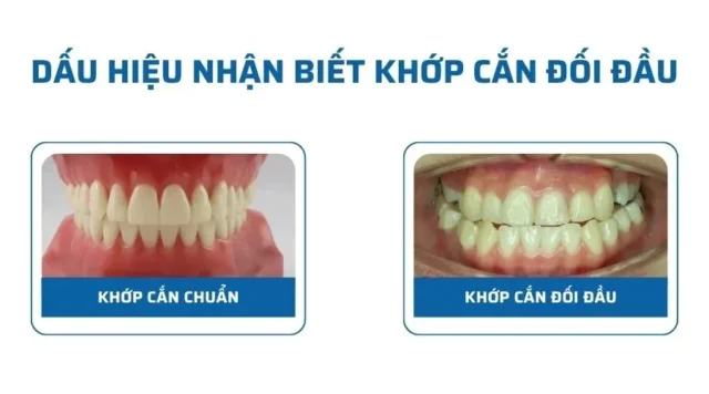 khớp cắn đối đầu
