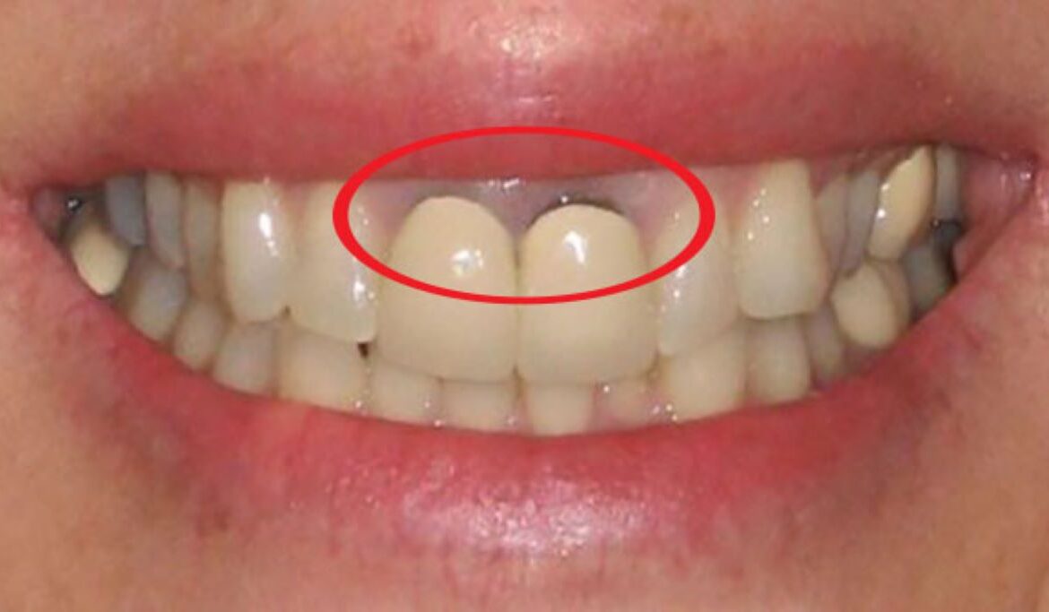 nướu răng bị đen