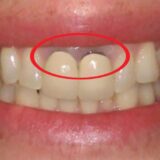 nướu răng bị đen