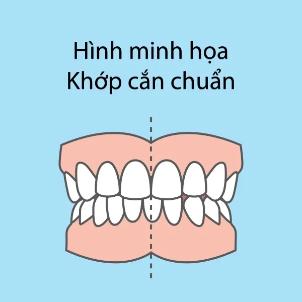 khớp cắn chuẩn