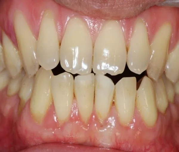 khớp cắn đối đầu