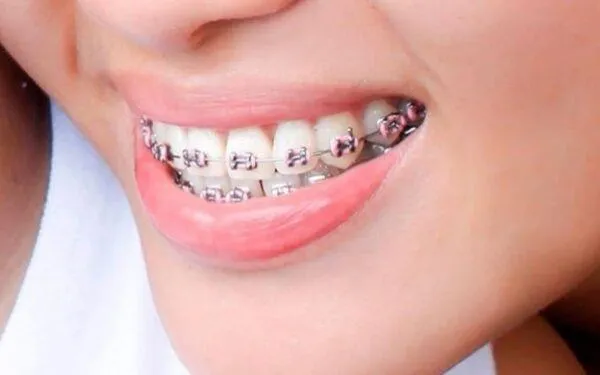 sai khớp cắn