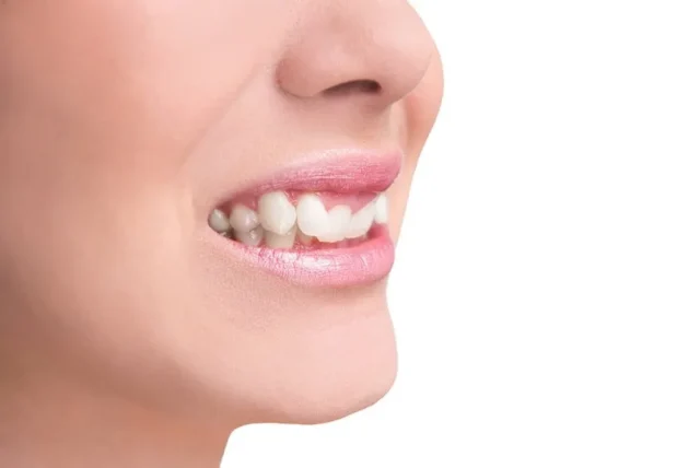 khớp cắn sâu