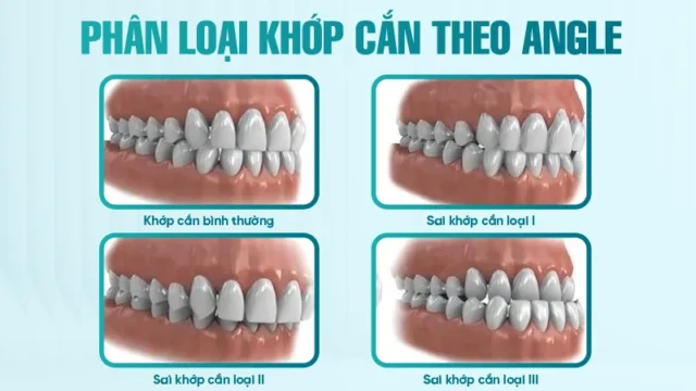 khớp cắn hạng 1