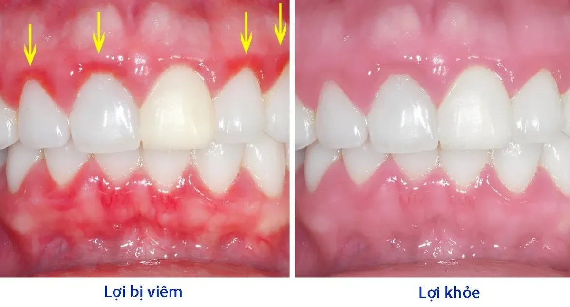viêm lợi răng hàm